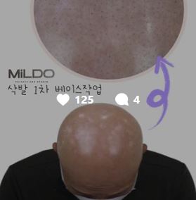 동래두피문신 &amp; MiLDO_SMP